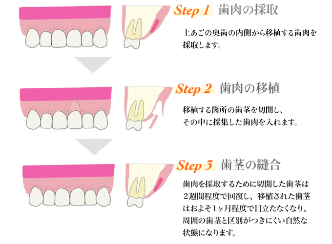 上あごの奥歯の内側から移植する歯肉を採取します。移植する箇所の歯茎を切開し、その中に採集した歯肉を入れます。歯肉を採取するために切開した歯茎は２週間程度で回復し、移植された歯茎はおよそ1ヶ月程度で傷跡が目立たなくなり、周囲の歯茎と区別がつきにくい自然な状態になります。